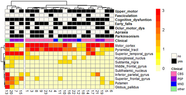 Heatmap and hierarchical clustering based on neuronal loss in 24 UMN‐predominant MND cases. Two distinct clusters are identified by hierarchical clustering based on neuronal loss. The heatmap reflects the severity of neuronal loss, and a color scale is given at the right. Missing data are shown in gray. Patients are represented with columns, and the study ID of each patient is provided. The main clinical features and diagnoses of each case are shown. CBS, corticobasal syndrome; PSP, progressive supranuclear palsy; MND, motor neuron disease; UMN‐predominant MND, upper motor neuron‐predominant motor neuron disease.