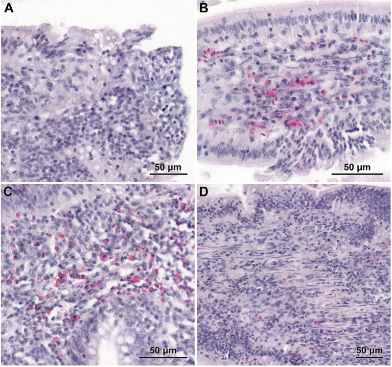 Histological structure of jejunum in C. perfringens infected chickens receiving CBD (A), CBD + nano-Se (B), and nano-Se (C, D). (A) The lack of epithelial cells on the apical part of the villus. (B) Shedding of enterocytes from the latter part of the villus. (C) Infiltration of inflammatory cells inside the villus. (D) Increased presence of smooth muscle cells within the stroma of villi.