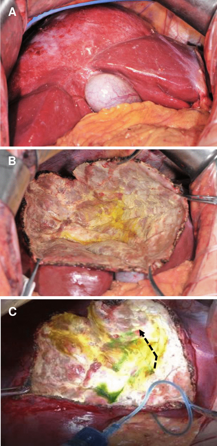 Example of intraoperative technique to discover cysto-biliary communication. a Surgical exposure of large echinococcal cyst; b posing cystic cavity for potential biliary leakage after partial peri-cystectomy plus total endo-cystectomy; c liquid spray (dotted arrow) form leakage site when injecting methylene blue (1:250 diluted with normal saline)