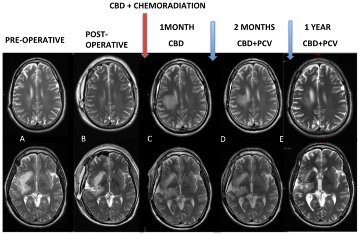(A,B) Pre and post-operative MRI. Red arrow: chemoradiation associated with cannabidiol in a dosage ranging from 300 to 450 mg/day. (C) Control MRI after 1 month of the end of the chemoradiation was characterized an exacerbated and ultra-precocious phenomenon of pseudoprogression with increased edema and inflammatory disease. (D,E) MRI controls demonstrated progressive reduction of these findings.