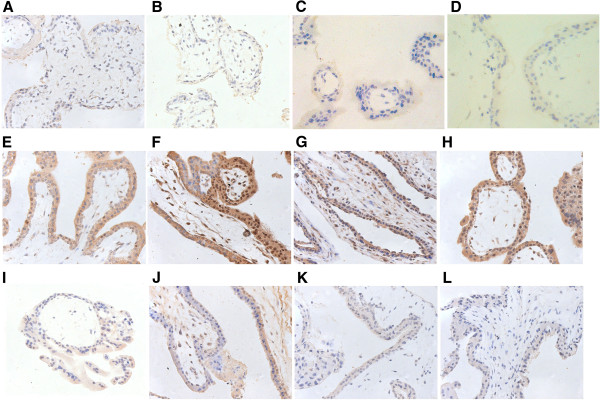Immunostaining of the chorionic villi in tubal pregnancy. Expressions of estrogen receptor (ER)-alpha (A, B), progestogen receptor (PR) (C, D), leukemia inhibitory factor (LIF) (E, F), vascular endothelial growth factor (VEGF) (G, H), inducible nitric oxide synthase (iNOS) (I, J) and endocannabinoid receptor (CB1) (K, L) in the chorionic villi observed by immunohistochemistry. Positive staining was detected in the chorionic villi from both the LNG-EC group (A, C, E, G, I) and the control group (B, D, F, H, J). The immunostaining for ER-alpha (A, B) and PR(C, D) was observed in the nuclei of cytotrophobast, syncytiotrophoblast, and stromal cells from both groups. The immunostaining for LIF (E, F), VEGF (G, H), iNOS (I, J) and CB1 (K, L) was seen in the cytoplasm of cytotrophobast, syncytiotrophoblast, and stromal cells from both groups. There were no significant differences between the two groups in the expressions of ER-alpha (A, B), PR (C, D), LIF (E, F), VEGF (G, H), iNOS (I, J) or CB1 (K, L). Magnification: 400×.