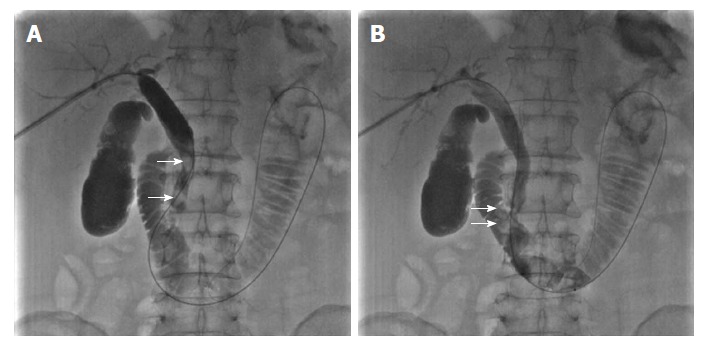 Empty balloon was then withdrawn above the stones, inflated, and used to push the stones into the duodenum through the sphincter of Oddi. A: The empty balloon was withdrawn above the common bile duct stones (white arrow) and then re-inflated. B: The common bile duct stones (white arrow) were pushed into the duodenum through the dilated sphincter of Oddi.