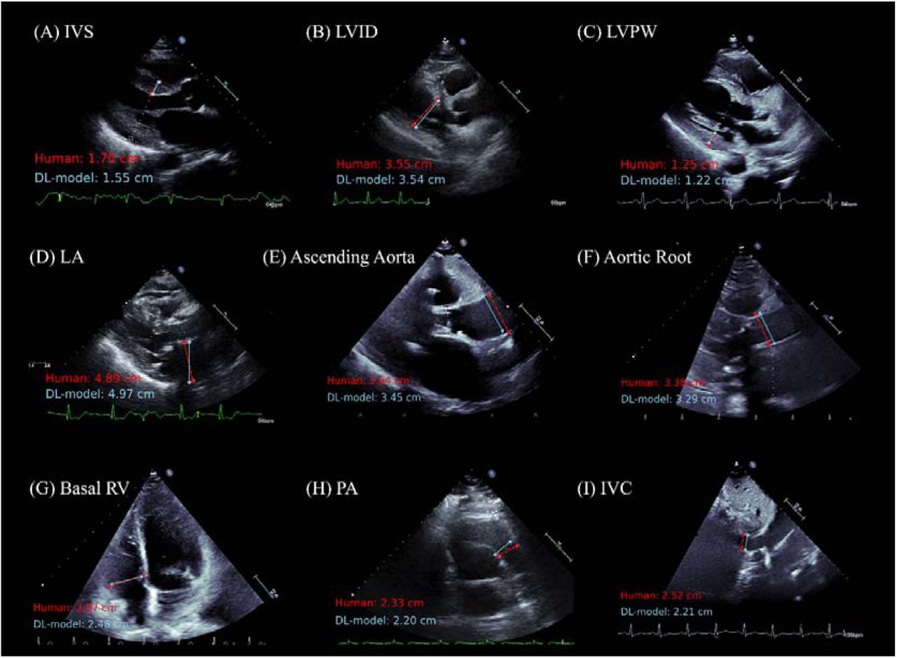 Representative Figures of Comparison between Sonographer and Deep Learning Model Measurements for Echocardiographic Linear Measurement ParametersThe figure showing a comparison of measurements made by a sonographer (in red) and predictions from the deep learning (DL) model (in light blue) across nine echocardiographic parameters. For a detailed explanation of echocardiography parameter abbreviations, refer to Table 1.