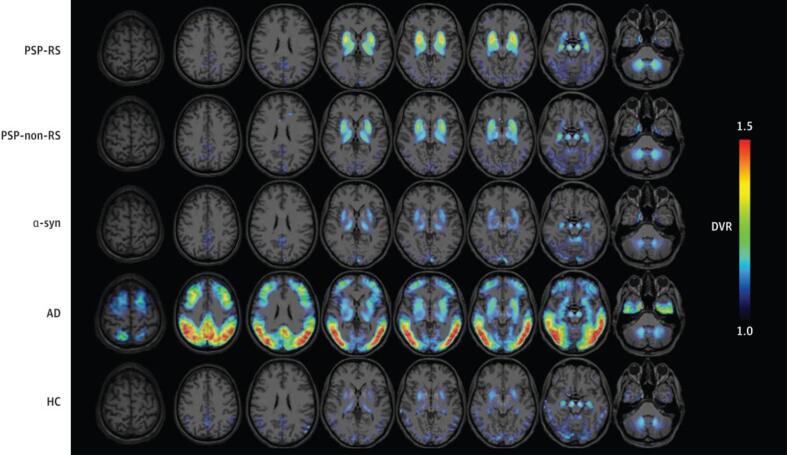 Representative [18F]PI-2620 distribution volume ratio (DVR) binding maps superimposed on standard MRI imaging templates for all disease cohorts. Differential tracer binding effectively distinguishes study groups. Binding is highest in the globus pallidus for PSP groups. PSP-RS = progressive supranuclear palsy-Richardson’s syndrome, PSP-non-RS = progressive supranuclear palsy-non-Richardson’s syndrome, a-syn = alpha-synucleinopathies, AD = Alzheimer’s disease, HC = healthy controls. Figure is reproduced from Brendel M, Barthel H, Van Eimeren T, Marek K, Beyer L, Song M, Palleis C, Gehmeyr M, Fietzek U, Respondek G, Sauerbeck J, Nitschmann A, Zach C, Hammes J, Barbe MT, Onur O, Jessen F, Saur D, Schroeter ML, Rumpf JJ, Rullmann M, Schildan A, Patt M, Neumaier B, Barret O, Madonia J, Russell DS, Stephens A, Roeber S, Herms J, Bötzel K, Classen J, Bartenstein P, Villemagne V, Levin J, Höglinger GU, Drzezga A, Seibyl J, Sabri O. Assessment of 18F-PI-2620 as a Biomarker in Progressive Supranuclear Palsy. JAMA Neurol 77: 1408–1419, 2020.
