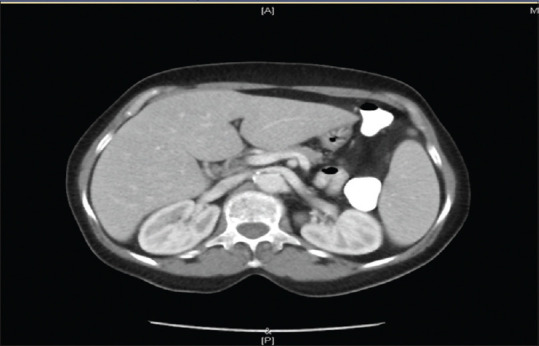 Computed tomography (CT) scan revealed mildly enlarged and fatty liver