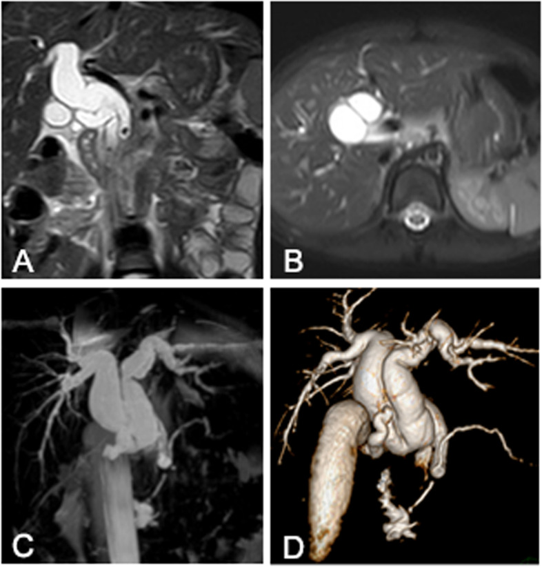 Preoperative MRCP showed the double common bile duct. A and B coronal and axial magnetic resonance T2-weighted image showed the low signal septum in the dilated common bile duct which divided the extrahepatic bile duct into two parts, which connected to the left and the right hepatic duct respectively. C and D coronal maximum intensity projection magnetic resonance image and volume rendering image showed the dilated and duplicated common bile duct