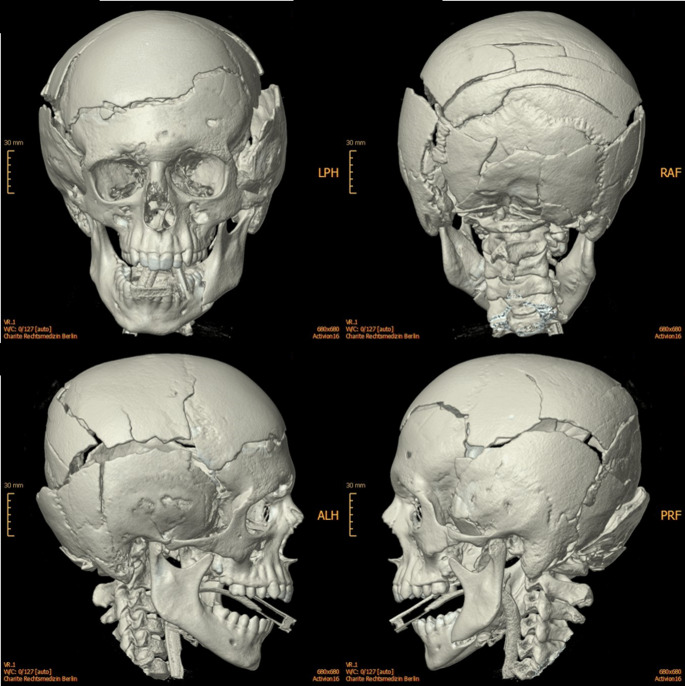 Multiple cranial fractures from impact against an obstacle (bridge)