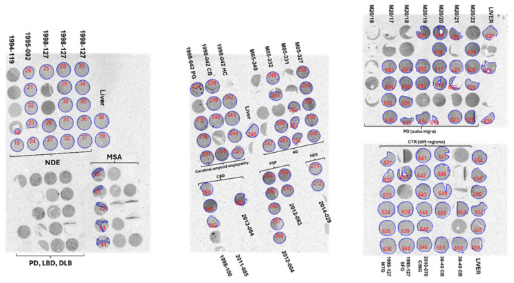 Representative ROIs selected in tissue microarray (TMA) autoradiography on which analysis was done for Table 3, Figure A5 and Figure A6. In the microarrays from PD (substantia nigra), the cores were selected based on the pathological evidence of α-syn inclusions, with no A-β plaques or pTau tangles. In the MSA cases, the ROIs were delineated on the areas where the binding of [3H]GMC-058 was observed and corresponded to areas with α-syn inclusions. The numbers are identifiers of the ROIs generated by the analysis software.