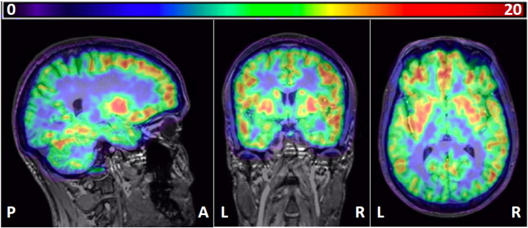 Example of a parametric map, co-registered onto the subject's MRI scan. Left, sagittal; middle, coronal; right, transverse. Note high binding in the putamen and pallidum and intermediate binding in the hippocampus and thalamus. Colour bar: VT values. P, posterior; A, anterior; R, right; L, left.
