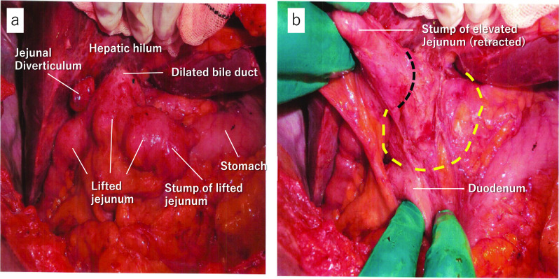 Intraoperative photographs which prove that the previous surgery was IDS. a Lifted jejunum is anastomosed to the ventral side of dilated bile duct with side-to-side anastomosis. A jejunal diverticulum was seen (cholecystectomy had been performed with this patient). b Dilated bile duct and anastomosis are exposed after mobilization of the lifted jejunum. A yellow dotted line shows dilated bile duct. A black dotted line shows side-to-side anastomosis with lifted jejunum (IDS)