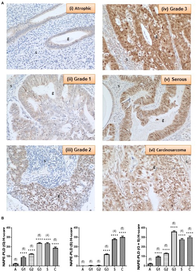 NAPE-PLD immunoreactivity increases in endometrial cancer. (A) Shows representative photomicrographs of immunoreactive NAPE-PLD staining in atrophic endometria and grade 1, 2, 3 type 1 EC, and serous and carcinosarcoma type 2 EC. Note the gradual change of staining in glandular epithelial cells (g) from the less to more advanced malignancy. Also note the apparent lack of staining in the stromal cells of the atrophic endometria. (B) Shows data from the histomorphometric analyses of the glands alone (G, left panel) and stromal tissue alone (S, middle panel) and for the entire tissue (G + S, right panel). NAPE-PLD staining was statistically significantly increased in all the EC when compared to the atrophic endometria. The results are presented as means ± SD. Statistical significance was determined using one way analysis of variance with Dunnett's ad hoc post-test analysis; ****p < 0.0001 compared to atrophic; n = 6 in all cases except for serous EC (where n = 4). The sample numbers are shown in parentheses above each bar.