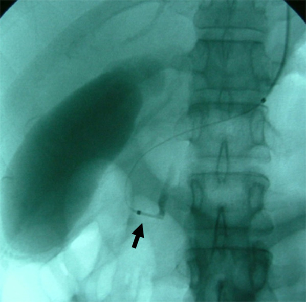 Cholangiography during endoscopic balloon dilatation (EBD). The burst balloon of the endoscopic balloon dilatation (EBD) at the site of the biliary sphincter. Arrow indicates the burst balloon of the EBD catheter at the site of the biliary sphincter