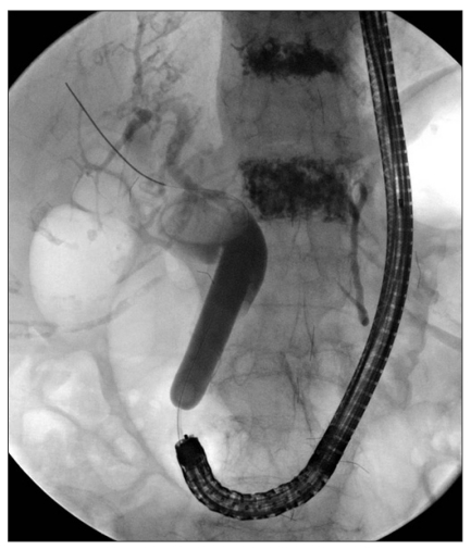 Endoscopic retrograde cholangiopancreatography showing the CRE wire-guided dilation, 12 mm in diameter.