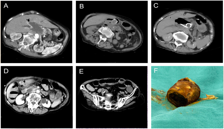 Five abdominal CT scans labeled A to E show different axial cross-sections with varying densities and anatomical structures. Panel F displays a cylindrical object with a brown surface, likely related to the CT findings, placed on a teal surgical drape.