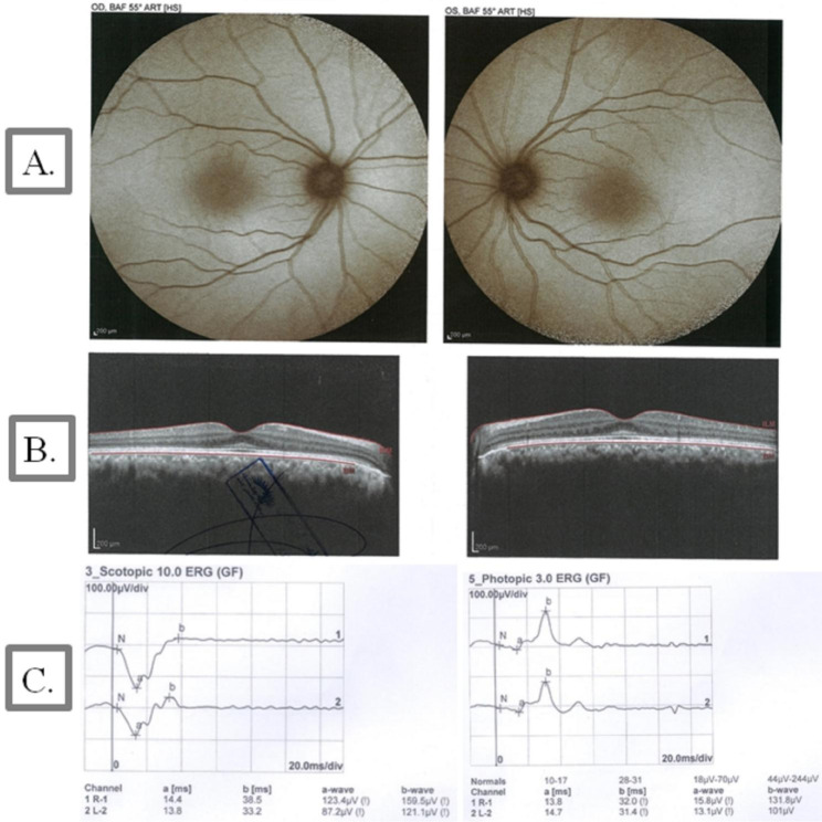 Fundus autofluorescence (FAF), optical coherence tomography (OCT) images, and electroretinography (ERG) in patient IV.2 with ABHD12 variants. (A) The eyes of an 18-year-old woman with Snellen BCVA of 9/10 and 8/10 for the right and left eye, respectively. FAF imaging was preserved in this case. (B) On OCT, loss of the ellipsoid zone was observed in the extrafoveal area. (C) ERG showed a significant reduction in the amplitude of the scotopic and photopic recordings