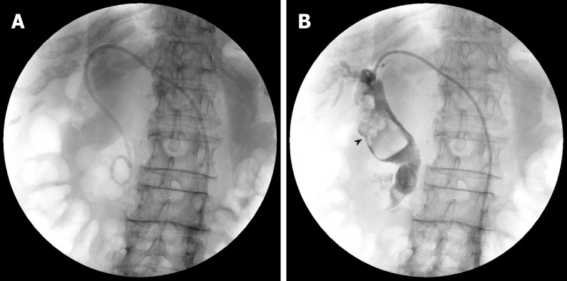 Cholangiography images in percutaneous transhepatic biliary drainage. A: A 6 Fr pig-tail extra drainage tube is inserted; B: Black arrow head shows huge common bile duct stones (over 50 mm).