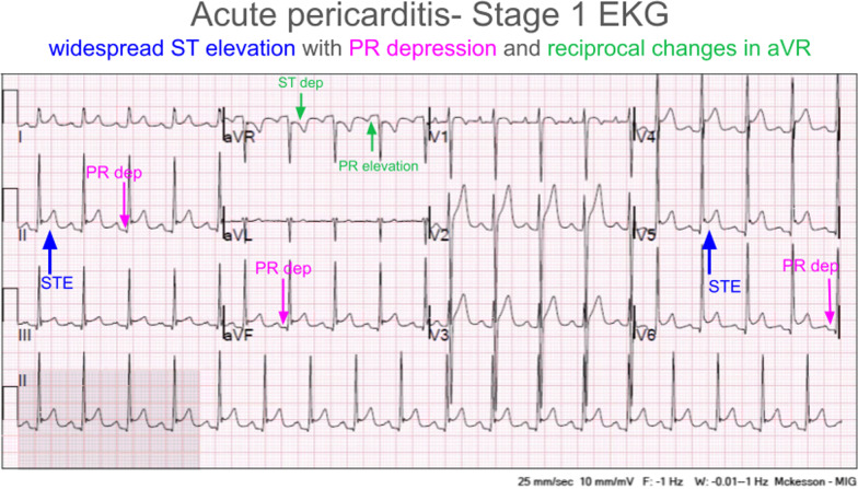 Twelve-lead EKG consistent with acute pericarditis. Red up arrow indicates diffuse concave ST elevations. Blue down arrow indicates hyperacute T waves. Plus symbol indicates PR depressions