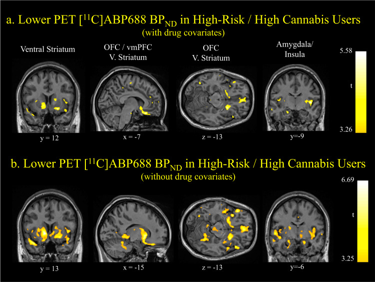 Lower [11C]ABP688 BPND in high EXT risk, high cannabis users: whole brain voxel-wise analysis.a T-maps illustrating significantly lower [11C]ABP688 BPND in high EXT risk, high cannabis users (n = 9) compared to all other participants (n = 50) in mOFC, ventral striatum and insula with other substance use (AUDIT, smoking status and drug use other than cannabis), sex and E-isomer ratio as covariates. Cluster-level ps < 0.05, FWE corrected. b T-maps illustrating significantly lower [11C]ABP688 BPND in high EXT risk, high cannabis users (n = 9) compared to all other participants (n = 50) in mOFC, ventral striatum and insula without other substance use as covariates (AUDIT, smoking status and drug use other than cannabis). Sex and E-isomer ratio were included as covariates. Peak-level ps < 0.05, FWE corrected.