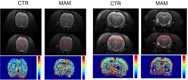 ASL image in the MAM model. The figure shows anatomical (T2 weighted) images in the top part, the delineation of regions of interest for the ASL analysis (central part) and perfusion map (bottom part) in one representative animal from each CTR and MAM exposed group. ROIs are numbered as follows. At +1.6 mm position from bregma: 1 – prefrontal cortex, 2 – caudate putamen; at −3.14 mm position from bregma: 3 – sensorimotor cortex, 4 – hippocampus, 5 – circle of Willis.