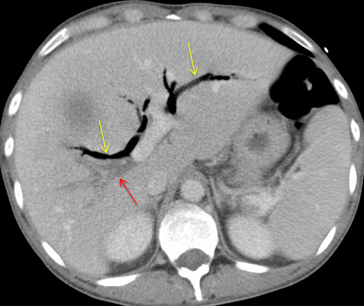 Additional view of CT abdomen and pelvis with IV contrast (axial view).The image shows the septic thrombosis of the right portal venous system (red arrow) with mildly distended intrahepatic biliary ducts and air in the biliary tree (yellow arrows).