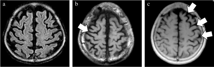 Visual rating scale of asymmetric atrophy. The degree of asymmetry in the frontal, temporal, parietal, and occipital lobes, and cerebral peduncle was assessed using a three-point scale (0 = normal, 1 = mild, and 2 = severe). In contrast to no obvious asymmetry in a patient with pathologically confirmed DLB (a), mild asymmetry and severe asymmetry were observed in patients with pathologically confirmed PSP (b) and CBD (c). CBD, corticobasal degeneration; DLB, dementia with Lewy bodies; PSP, progressive supranuclear palsy