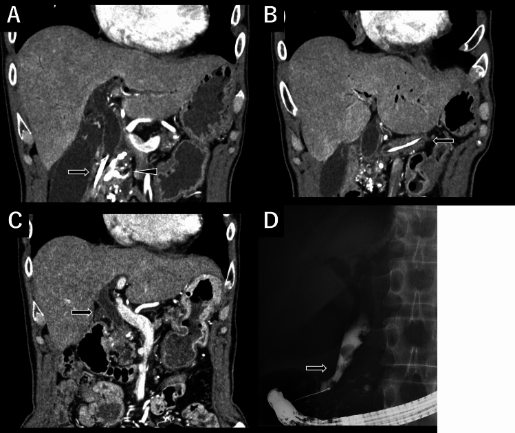 Imaging studies of a case with improvement of a CBD stricture 53 months after the Frey procedure. A Preoperative computed tomography (CT) revealing calcification in the pancreatic head (arrowhead) and a CBD stent in place (arrow). B Preoperative CT imaging showed the pancreatic duct stent in place. C At 53 months after surgery, the CBD stricture had resolved. D Although CBD dilation was still observed, the CBD stent was no longer required