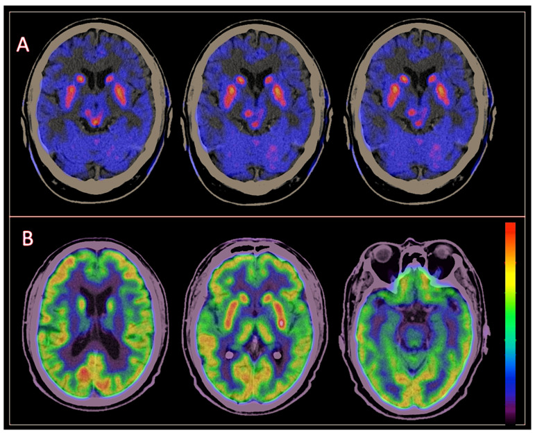 63-year-old male who presented clinically with motor symptoms, which started 3 years ago and had progressed from the right hemibody to subsequently both sides; her symptoms were characterized by bradykinesia, intentional and postural tremor, gait alteration, and non-motor symptoms, like depression, hallucinations, and REM sleep behavior disorders. In the assessment made by the movement disorders experts, rapid progression, pyramidalism, symmetry, and dysautonomia stood out. They raised the possibility of MSA-P vs. PD. The dual cerebral PET-CT study shows the following: (A) FDOPA PET demonstrates decreased uptake in both putamen nuclei, predominantly in the left posterior third. (B) FDG PET demonstrates hypermetabolism in the posterior third of the left putamen and preserved metabolism in the cerebral cortex, cerebellum hemispheres, and the rest of the striatal nuclei. Imaging findings are consistent with PD.