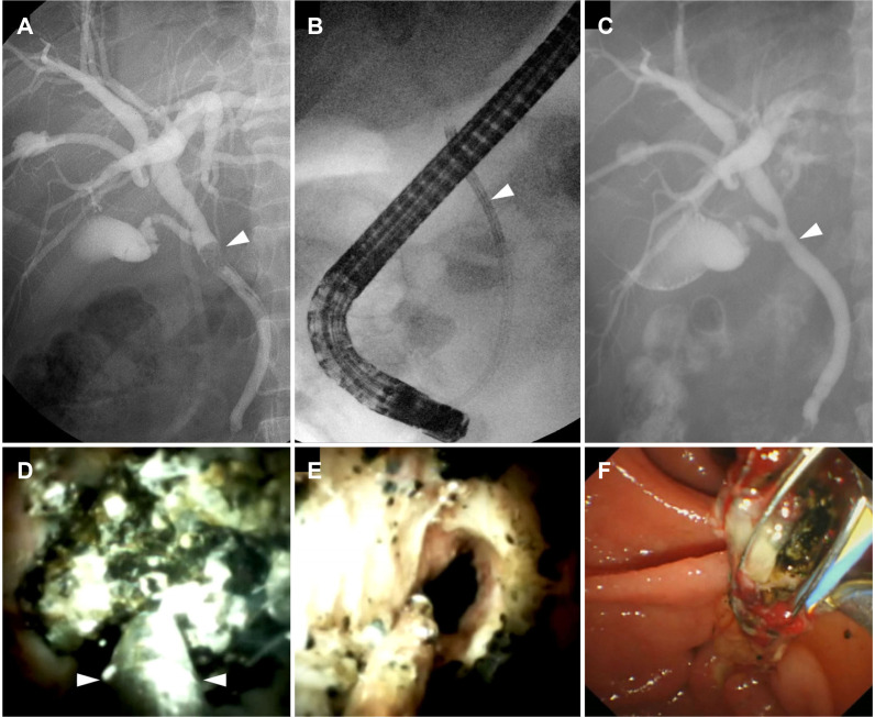 Single-operator cholangioscopy-guided electrohydraulic lithotripsy (EHL). (A) Fluoroscopy image showing an impacted bile duct stone (arrowhead). (B) X-ray image showing SpyScope (arrowhead) inserted into the bile duct. (C) Final cholangiogram showing no residual filling defect. (arrowhead). (D) SpyGlass showing an impacted stone. EHL (arrowheads, EHL probe) is performed under direct visualization. (E) SpyGlass showing the cleared bile duct after EHL. (F) Fragmented bile duct stones are extracted using a stone basket after lithotripsy.
