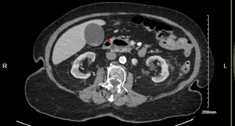 Large periampullary diverticulum at distal common bile duct (CBD) (Red Star) causing CBD dilatation.