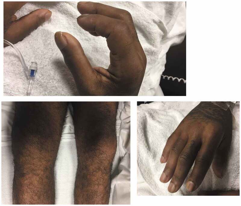 Swelling and pain of the hands, legs, and feet, as well as some new clubbing of all the fingers.