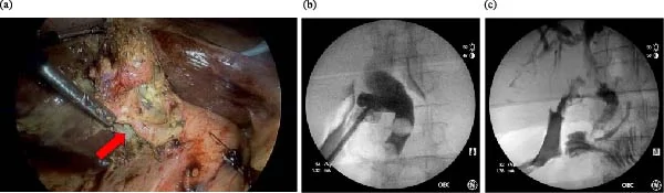 Intraoperative findings and cholangiography. (a) Laparoscopic view showing dense inflammatory adherence between the gallbladder fundus and hepatic flexure at the site of the cholecystocolonic fistula (arrow). (b) Initial intraoperative cholangiogram demonstrating a dilated cystic duct and common bile duct with multiple filling defects and no passage of contrast into the duodenum. (c) Completion intraoperative cholangiogram following bile duct exploration, interpreted as showing no residual filling defects and free passage of contrast into the duodenum.