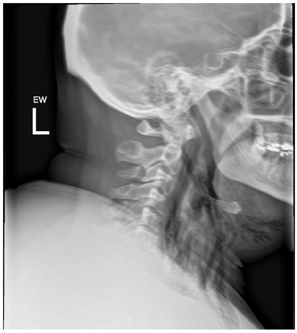 X-ray showing neck and soft tissue: clear areas of subcutaneous emphysema 6/2022, patient experienced shortness of breath and discomfort.