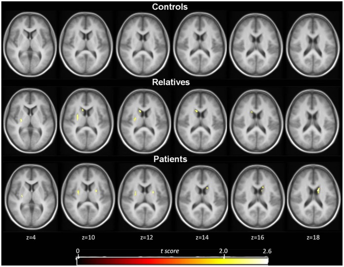 Mean statistical parametric t map of γ showing only the striatal voxels that show significant dopamine release surviving the t >2.4 threshold (p<0.01) in controls (top row, n = 9), relatives (middle row, n = 8) and patients (bottom row, n = 7).T maps are shown at the level of t >2.4 in transversal sections overlaid on a MRI template.