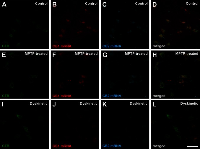 Co-expression of CB1R and CB2R mRNA in pallidothalamic neurons in control, parkinsonian and dyskinetic monkeys. Immunofluorescent detection of transported CTB combined with dual fluorescent in situ hybridization for the detection of CB1R and CB2R mRNA. All pallidothalamic projecting neurons (green channel) co-expressed CB1R (red channel) and CB2R (blue channel) mRNA. CB2R mRNA was expressed at lower levels than CB1R mRNA across all experimental conditions. Most importantly, there was a marked reduction in expression levels for both CB1R and CB2R mRNA transcripts in the dyskinetic state. Scale bar is 50 μm for all panels