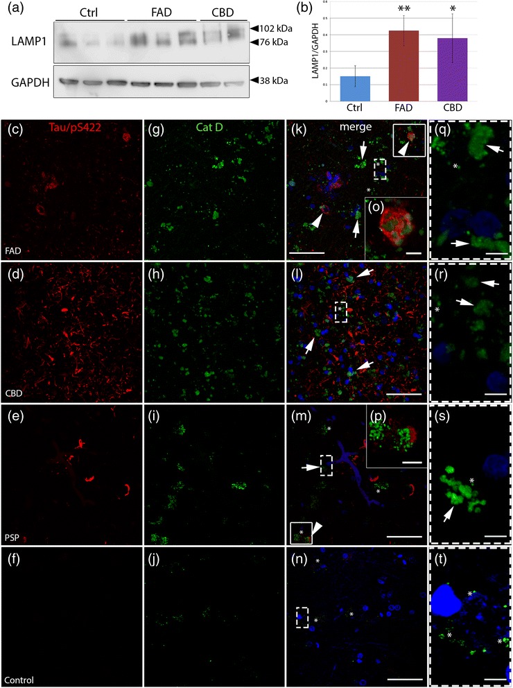 Accumulation of lysosomal markers and diffuse cytoplasmic Cat D immunoreactivity in tauopathies. a Western blot analysis of LAMP1 in human post-mortem brain (frontal cortex) extracts from control individuals (Ctrl, n = 3), early onset familial AD (FAD, n = 3) and CBD (n = 2). b LAMP1 levels quantified by densitometry and normalized to GAPDH in Ctrl, FAD and CBD. Results are shown as the mean value of arbitrary unit ± S.D (mean of three independent experiments). c-t Double immunohistochemistry against hyperphosphorylated tau (Tau/pS422, red, c-f) and Cat D (HPA003001, Sigma-Aldrich) (green, g-j) are shown by confocal analysis. k-n Merged pictures with nuclear staining (DAPI, blue). In FAD, CBD and PSP cases, strong Cat D-immunoreactivity is present in the soma of the cells in frontal cortex compared to the control. k-m (and high magnification q-s) Distinct vesicle-like structures (asterisks) and diffuse immunoreactivity (arrows) of Cat D throughout the cell bodies are shown in the pictures. In addition, in FAD and PSP, arrowheads in k and m and high magnification pictures (o-p) of boxed areas show hyperphosphorylated tau-positive structures close to Cat D-positive structures. t Brain tissues from control individuals show few Cat D-positive vesicle structures (asterisks). Scale bars: 50 μm (5 μm high magnification)