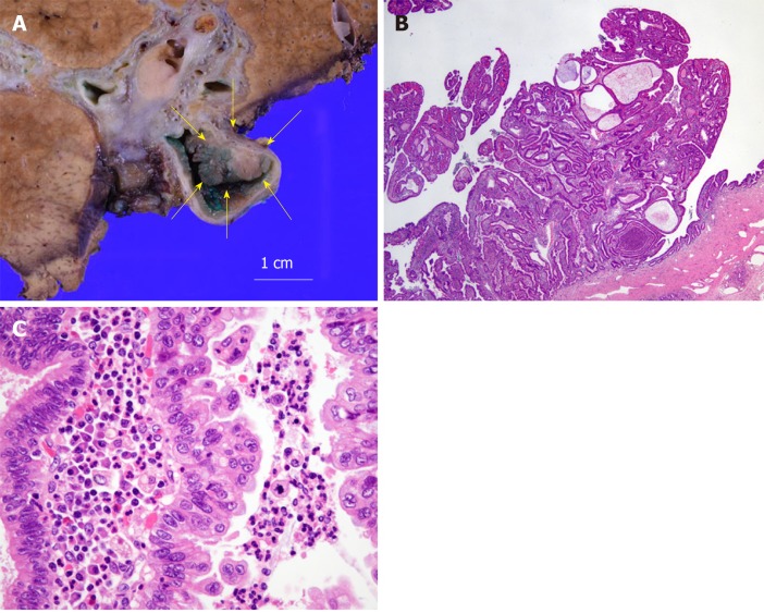 Histological analysis of the tumor. A: Macroscopic findings; B: Hematoxylin and eosin (HE) staining, × 20; C: HE staining, ×400. Histological studies show papillary growth and fibrovascular cores in the macroscopically nodular area (yellow arrow), comprising high-grade atypical epithelial cells. There is no invasive carcinoma associated with the intraductal neoplasm.