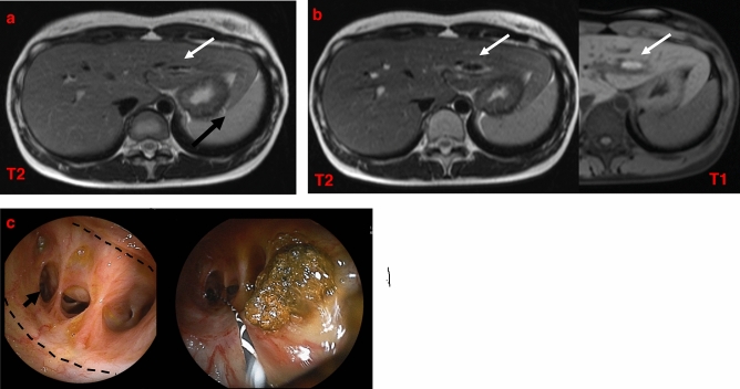 Case 6 from Table 1. (a) No abnormalities are seen in MRCP 20 years after radical surgery. (b) Twenty-five years after radical surgery, MRCP identifies intrahepatic bile duct dilatation and stones. (c) Bile duct mucosa is found in front of the stenosis. There is no stenosis at the anastomosis (dotted line). The stricture is noted in the second part of the bile duct. (arrow) Lithectomy is performed at DBERC. DBERC double-balloon endoscopic retrograde cholangiography, MRCP magnetic resonance cholangiopancreatography.