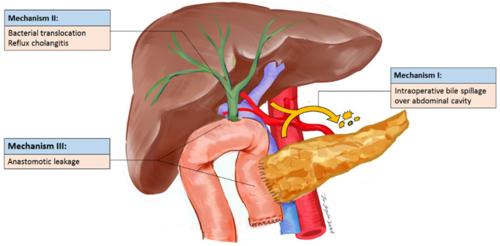 Potential mechanism of intra-abdominal abscess.
