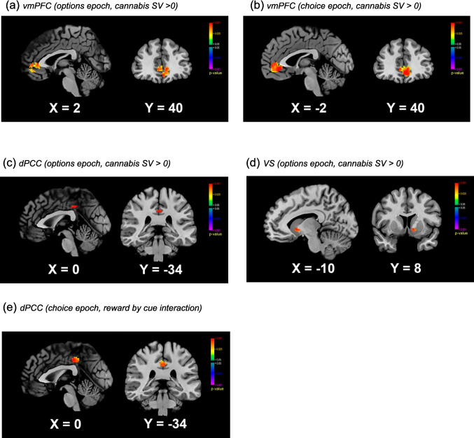 Region of interest masked, parametrically modulated fMRI results for the cannabis subjective value (SV) signal (cannabis > 0): (a) vmPFC (options epoch), (b) vmPFC (choice epoch), (c) dPCC (options epoch), and (d) VS (options epoch). (e) Reward by cue interaction in SV signals in dPCC (choice epoch). vmPFC = ventromedial prefrontal cortex; dPCC = dorsal posterior cingulate cortex; and VS = ventral striatum) vmPFC (options epoch, cannabis SV > 0) (b) vmPFC (choice epoch, cannabis SV > 0)