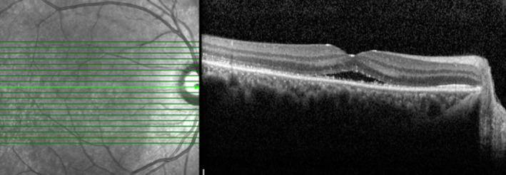 Infrared reflectance and B‐scan OCT images showed decreased SRF 1 month after the treatment initiated.