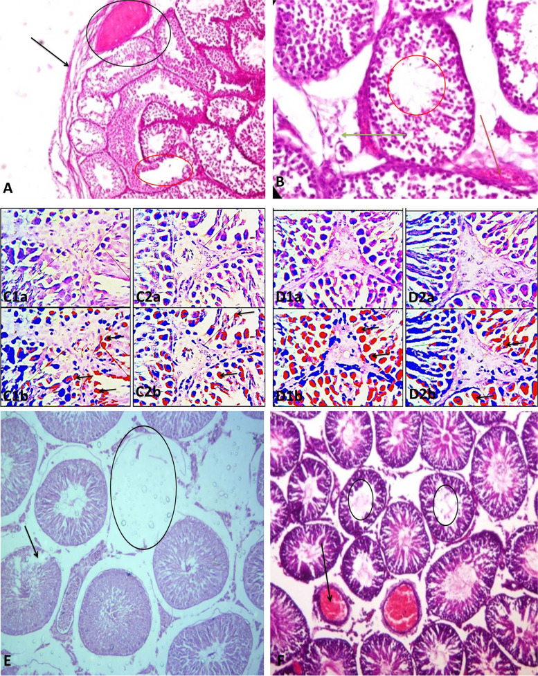 Effect of selected psychoactive drugs on testicular histoarchitecture. A-B) Codeine-treated rabbits showed distorted testicular architecture. The seminiferous tubules showed thickened propria indicative of cessation of spermatogenesis (black arrow). There are vacuolation, sloughed germ cells, maturation arrest, and reduced mature sperm cells within the tubular lumen (red circle). There is evidence of vascular congestion (black circle and red arrow). The leydig cells appear reduced (green arrow). (Photomicrographs are from our laboratory-published: [12]. Plate C1a and 1b are the original and pseudo images respectively of the testicular histoarchitecture of vehicle-treated control rats compared with those of codeine-treated rats (C2a and 2b) showing p53 expression. Codeine treatment led to significantly increased p53 expression. Also, plate D1a and 1b are the original and pseudo images respectively of the testicular histoarchitecture of vehicle-treated control rats compared with those of codeine-treated rats (C2a and 2b) showing Bcl-2 expression. Codeine treatment led to marked reduction in Bcl-2 expression. These findings are suggestive of codeine-induced apoptosis. (Photomicrographs are from our laboratory-published: [8]. E) Rohypnol treatment led to degeneration of seminiferous tubules (black circle) and germ cells (black arrow), with widened interstitial space. (Photomicrograph is from our laboratory-In Press, [9]. F) Methamphetamine caused degeneration of germ cells and reduced mature sperm cells in the tubular lumen (black circle). It also led to vascular congestion within the interstitial space (black arrow). (Photomicrograph is from our laboratory-unpublished)