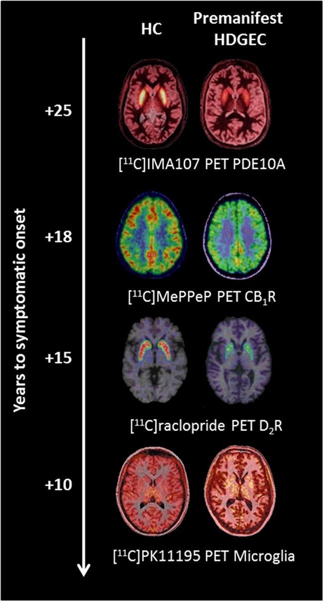 Changes in molecular positron emission tomography (PET) biomarkers in premanifest Huntington’s disease expansion gene carriers (HDGECs) compared to healthy controls (HC) as the disease progresses toward symptomatic onset. Axial [11C]IMA107, [11C]MePPeP, [11C]PK11195, and [11C]raclopride PET images coregistered and fused to corresponding T1-weighted MRI to show changes in premanifest HDGECs compared to HC. Earliest loss of striatal phosphodiesterase 10A (PDE10A) is detectable on average 25 years before symptomatic onset, followed by loss of cortical cannabinoid type 1 receptor (CB1R), increased microglia activation, and loss of striatal dopamine type 2 receptor (D2R) binding. Images produced from our data.