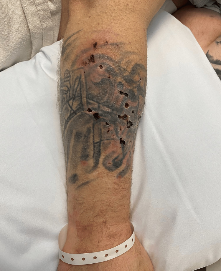 Xylazine-induced necrotic skin ulcerations along the right posterolateral forearm with associated erythema.