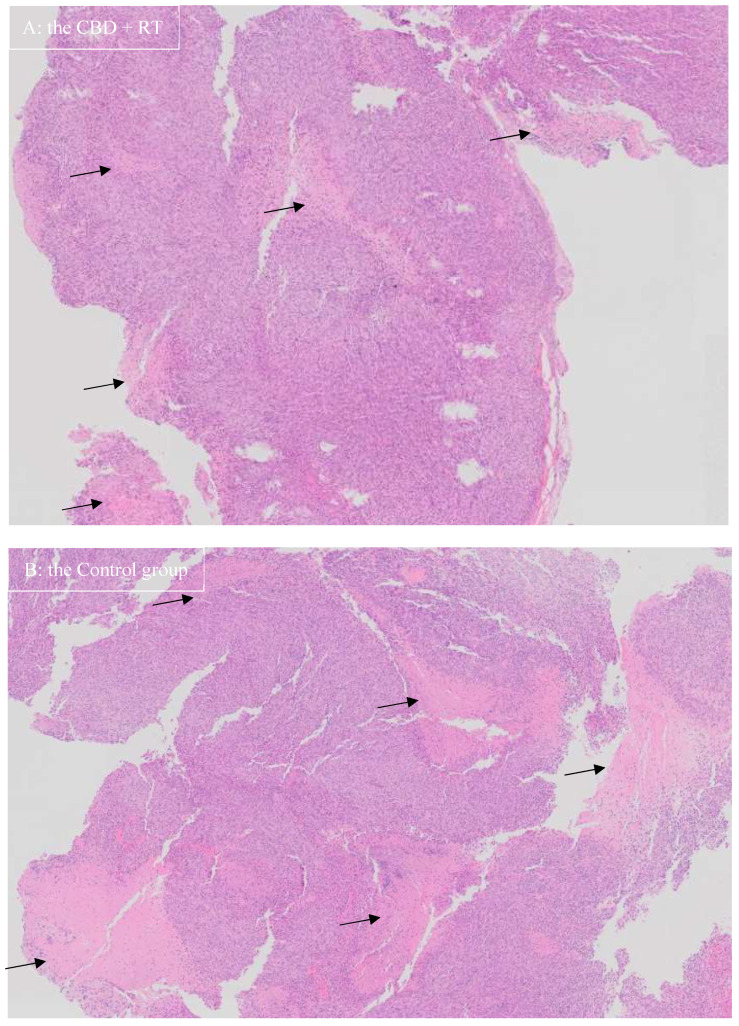 Hematoxylin and eosin stain of J3TBG glioma in the mice brain that shows highly invasive nature: the picture on the top (A) from a mouse in the CBD + RT group, the picture on the bottom (B) from a mouse in the Control group (magnification ×2). Necrotic areas (black arrows) are more pronounced in the Control group than in the CBD + RT group.
