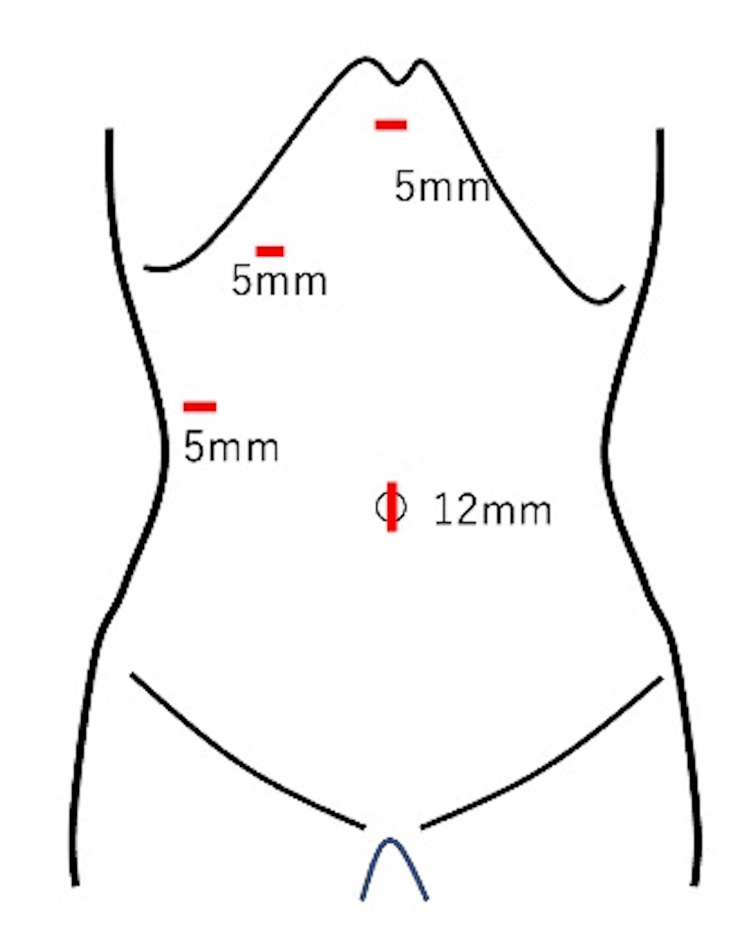 Case 2: Schematic illustration of laparoscopic cholecystectomy.Schematic illustration showing insertion of a 12-mm camera port through the umbilicus and three 5-mm subcostal ports during laparoscopic cholecystectomy.