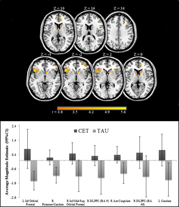 Regions of significantly greater activation in participants completing 18 months of CET, compared to TAU, during the emotional faces n-back task.