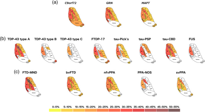 Pattern of atrophy in the thalamic nuclei in the (a) genetic; (b) pathological; and (c) clinical FTD groups. The cartoon is a schematic representation of an axial view of the thalamic nuclei and is not anatomically accurate. Colour bar denotes the % difference in volume from controls