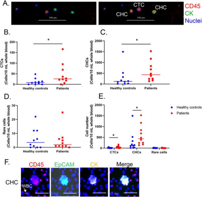 Number of cell counts in the peripheral blood of normal volunteers and patients with stage IV CRC. A. Representative images of typical circulating tumor cells (CTCs, CK+/CD45−) and circulating hybrid cells (CHCs, CK+/CD45+ isolated by the IsoFlux system (right panel) and counted by imaging software: Gen5 3.08 (left panel); scale bar, 100 μm B the number of circulating tumor cells (CTCs, CK+/CD45−) p value = 0.045 C the number of circulating hybrid cells (CHCs, CK+/CD45+) p value= 0.029 D the number of tumor-associated circulating endothelial cells (rare cells) p value= 0.979; E the number of CTC, CHC and rare cells F representative images of CHC (CK+/ EpCAM+/CD45+) detected by a GeoMx® instrument; scale bars, 50 μm. The Mann–Whitney U test or the T test was used to compare whether there was a difference in the dependent variable between the two independent groups. Statistical significance was established at p value < 0.05