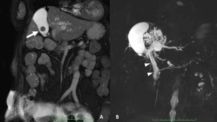 Case 1: Magnetic resonance cholangiopancreatography (MRCP).MRCP showed cholecystitis (A, white arrow) and choledocholithiasis (B, white arrowhead). Sludge-like, friable gallstones were observed in the common bile duct (B, white arrowhead). The gallbladder was positioned between the right and left hepatic lobes, with the cystic duct located deep within the liver parenchyma.
