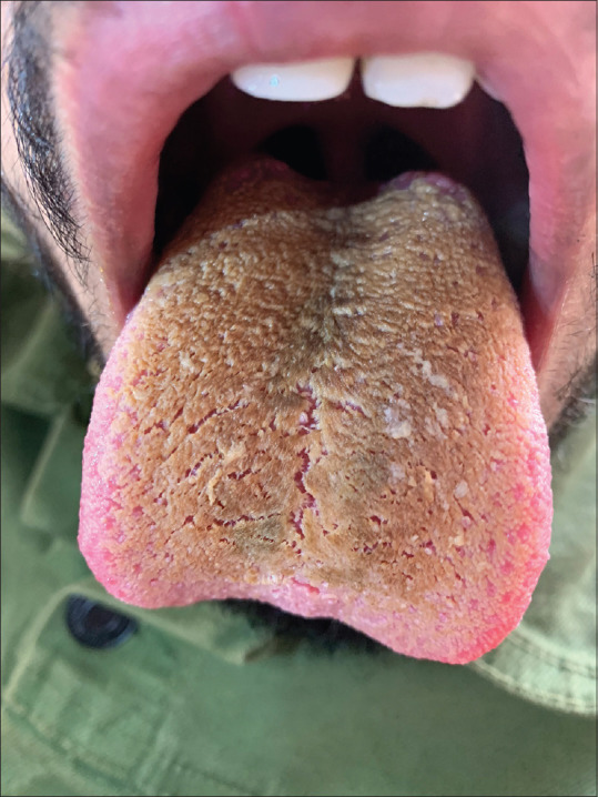 Oral hairy tongue as brown to blackish thickened plaques over the tongue which are difficult to remove
